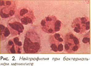 Нейтрофилия при бактериальном менингите