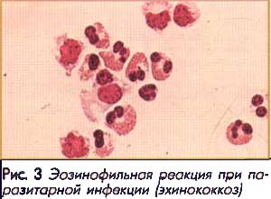 Эозинофильная реакция при паразитарной инфекции