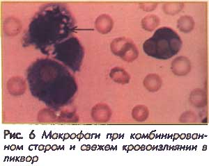 Макрофаги при кровоизлиянии в ликвор
